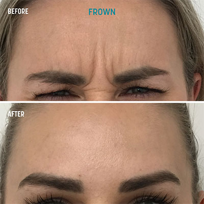 Forehead Frown Lines Botox