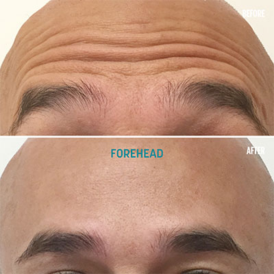 Male Forehead