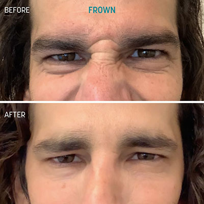 Male frown lines