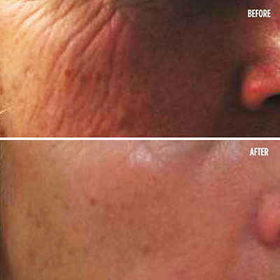 Dermapen Before and After