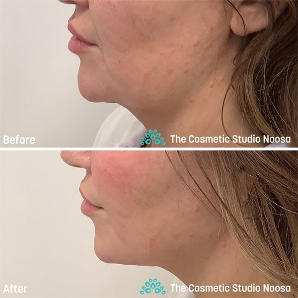 Jawline Filler - Before and After