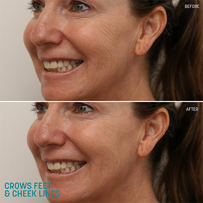 Before and After Crows Feet Treatment