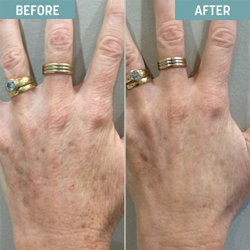 Before and after hand filler treatment