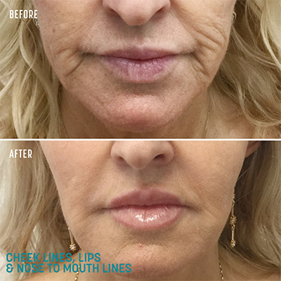 Before and After Mouth lines Skinbooster RF