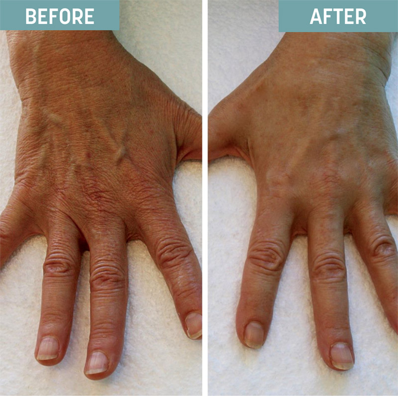Hand Filler - Before and After