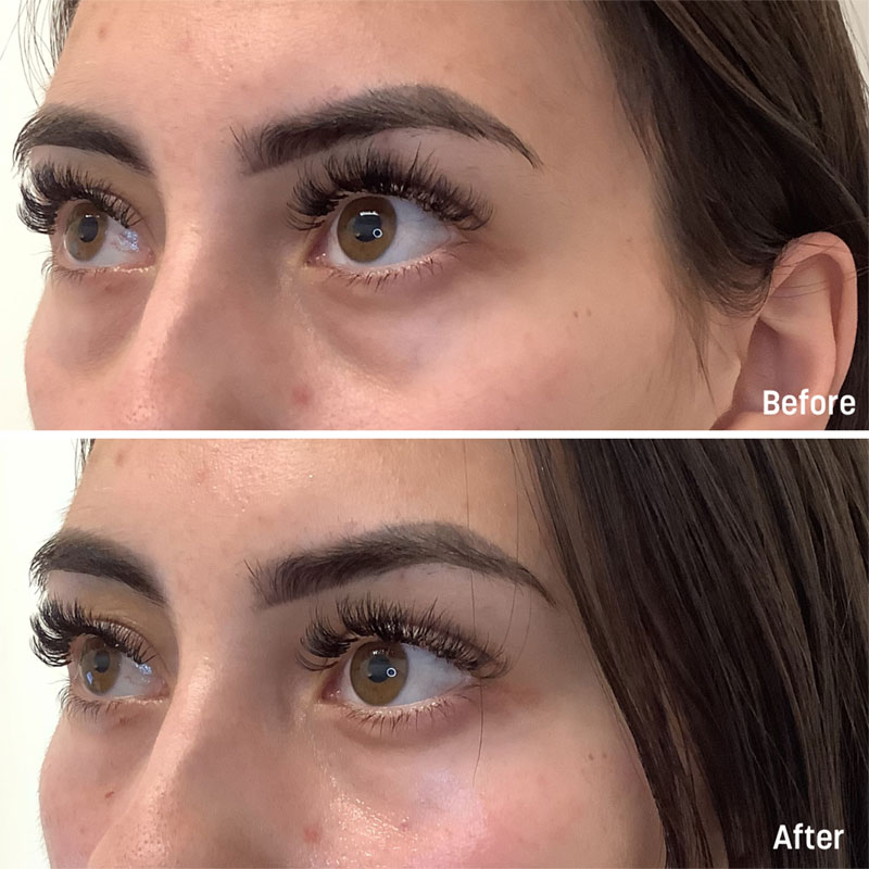 Under Eye Filler - Before and After Treatment