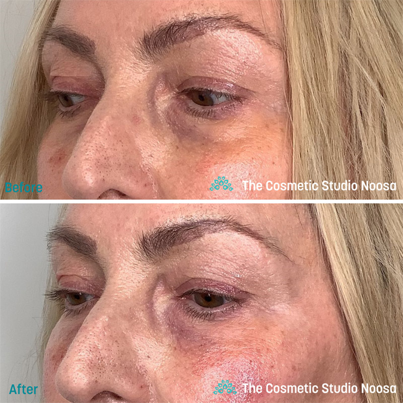 Under Eye Filler - Before and After