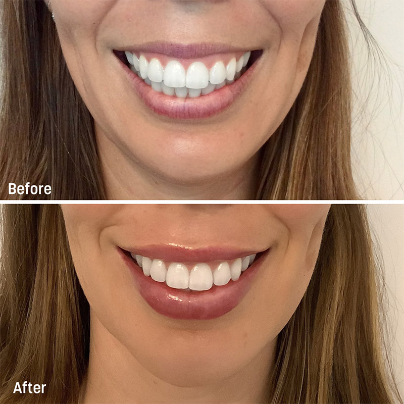 Before and After Gummy Smile Treatment