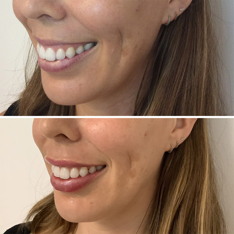 Before and After Treatment for Gummy Smile Treatment