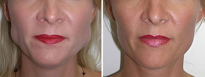 Jawline Slimming Before and After