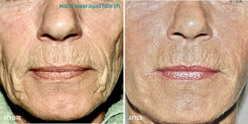 Before and after photos of a liquid face lift