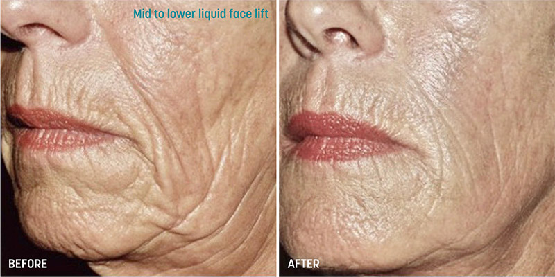 Before and after photos of a Sculptra Face Lift