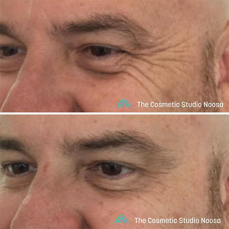 Smooth eyes after treatment